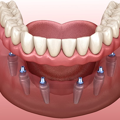 Diagram of implant dentures in North Garland