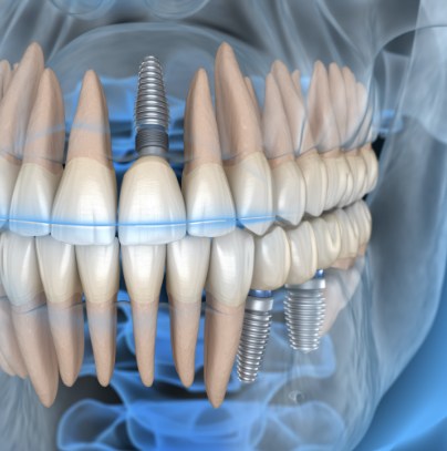 Animated smile with dental implant supported dental  crown