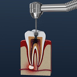 Illustration of a root canal in Garland, TX