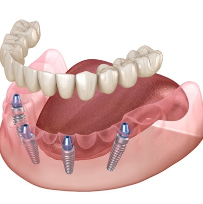 diagram of All-On-4 implants in Garland (for How All-On-4 Works section)