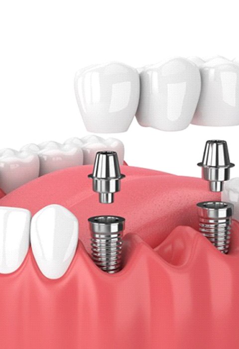 Illustration of implant bridge