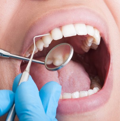 Dentist with blue gloves using tools to examine patient's teeth