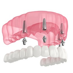 All-On-4 dentures