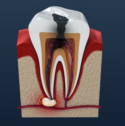 Animated tooth in need of root canal therapy