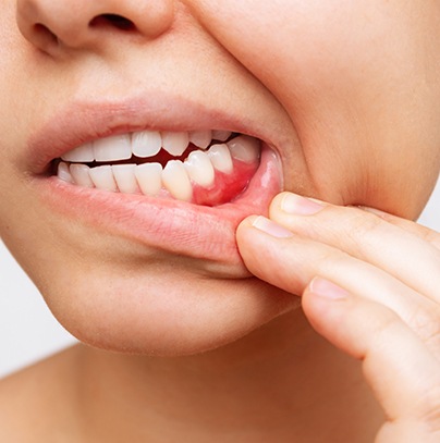 Closeup of woman with red, swollen gums