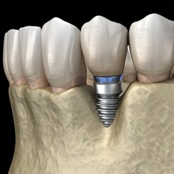 Dental implant in Garland