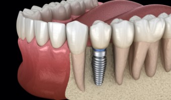 Animated smile with dental implant supported dental crown