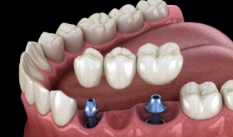 Animated smile with dental implant supported fixed bridge