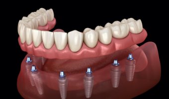 Animated smile with dental implant supported denture