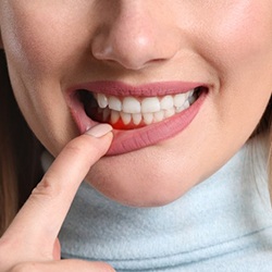 a woman showing signs of gum disease
