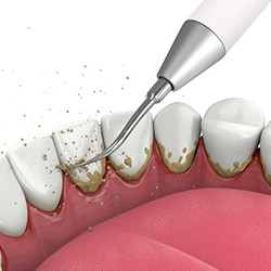 a 3D example of the scaling and root planing treatment