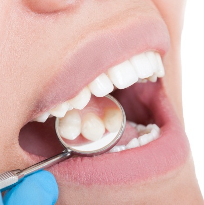 Dentist examining patient's smile after tooth colored filling treatment