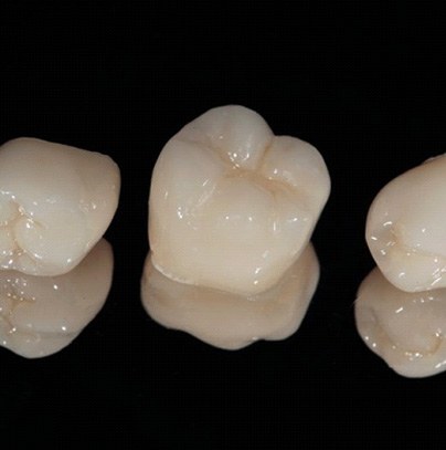 Animated smile during dental crown supported fixed bridge placement