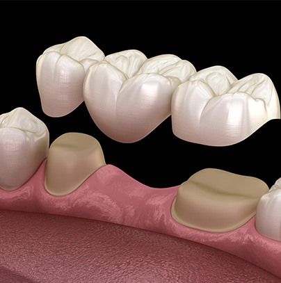 Dental crowns
