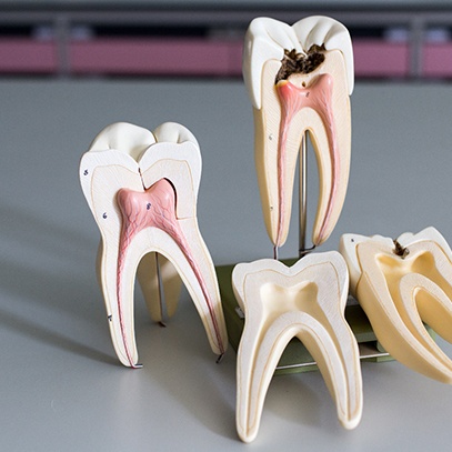 a model showing the inner chamber of a tooth