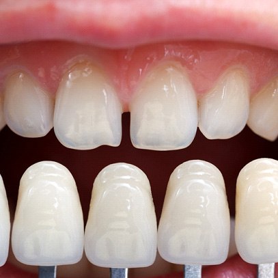 shade guide being compared to a set of teeth