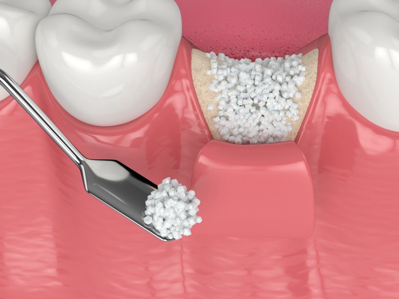 illustration of a bone graft in Garland