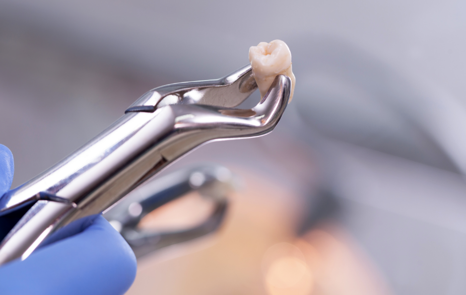 Extracted tooth on forceps